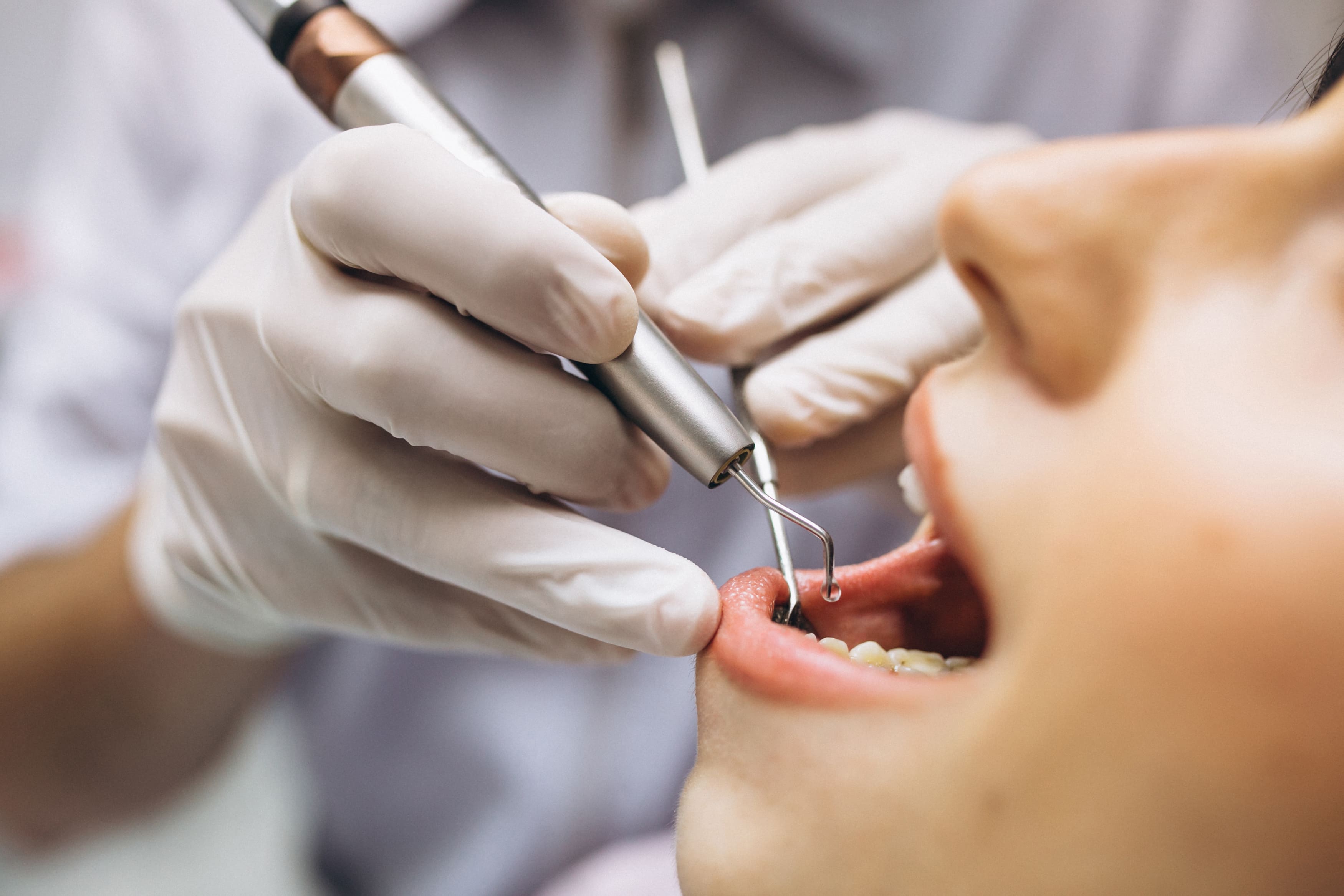 ¿Cada cuánto deberías hacerte una higiene dental