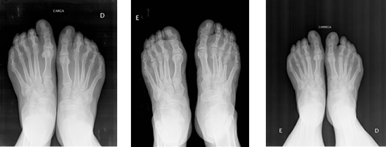 Resultat del tractament quirúrgic amb cirurgia percutània o mínimament invasiva de la metatarsàlgia per insuficiència del primer radi. Examen radiològic preoperatori, postoperatori immediat i postoperatori al cap de 6 mesos.