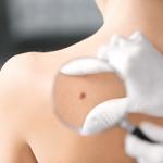 ¿Qué es el cáncer de piel tipo melanoma?