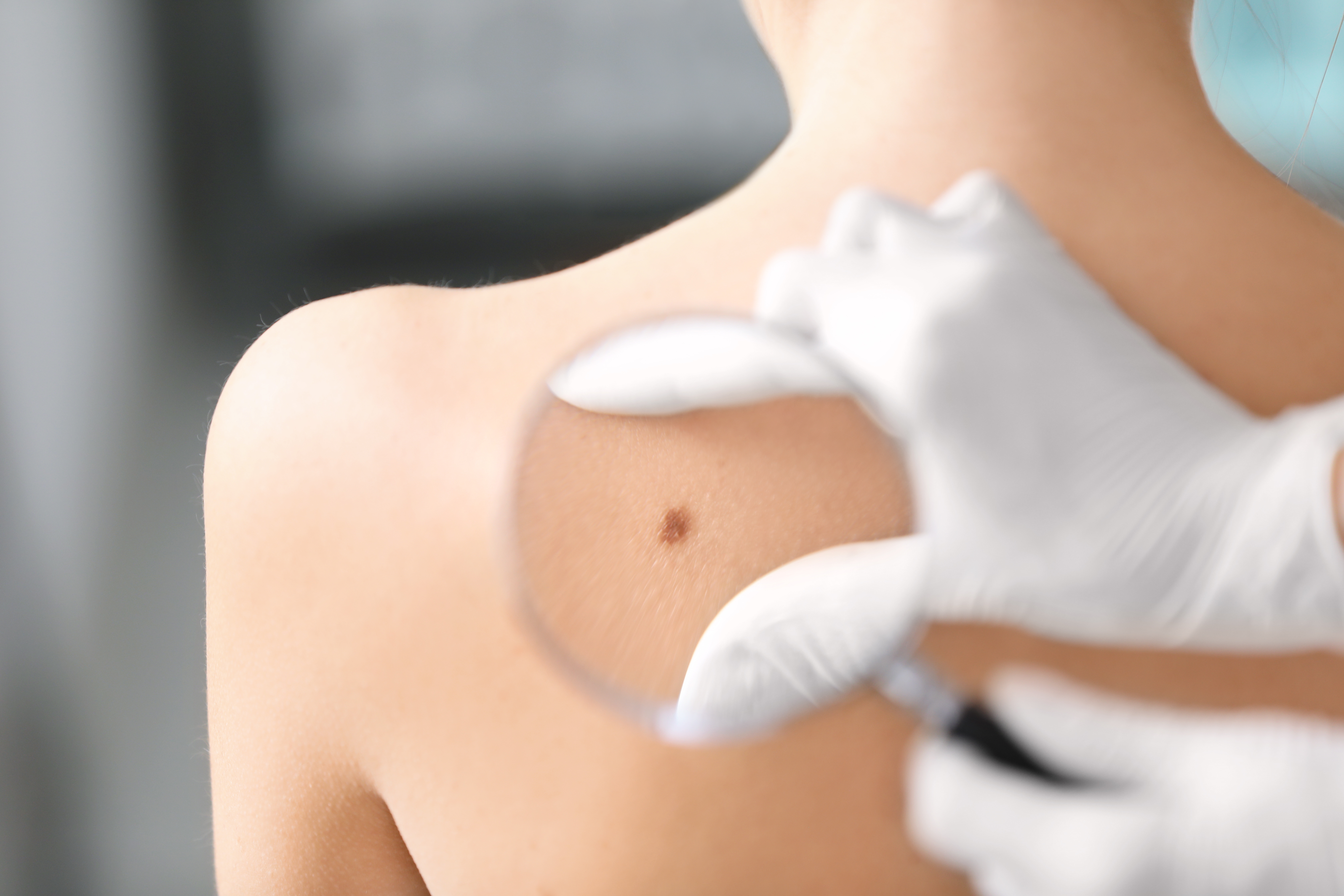 Què és el càncer de pell tipus melanoma?